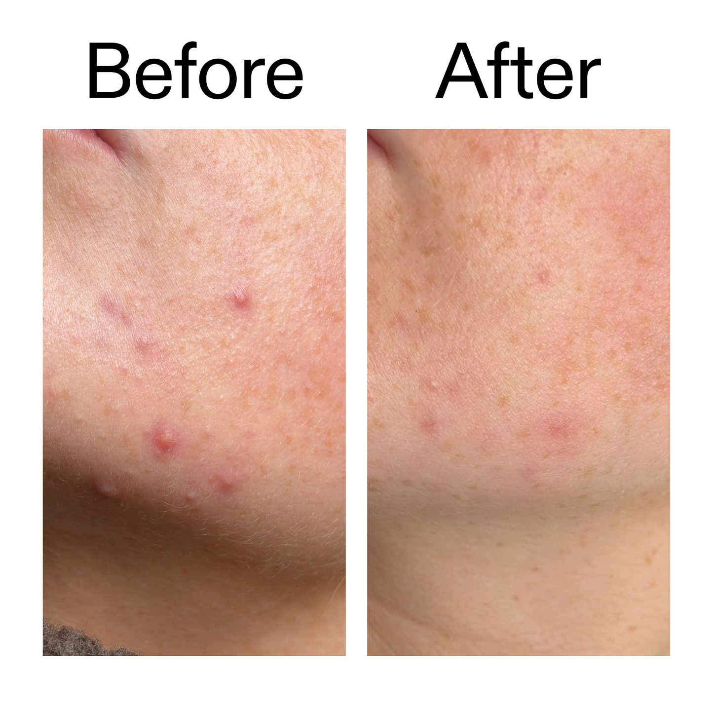 10-azelaic-acid-serum-for-redness-relief-b8 B_A_1_PPAGE.png