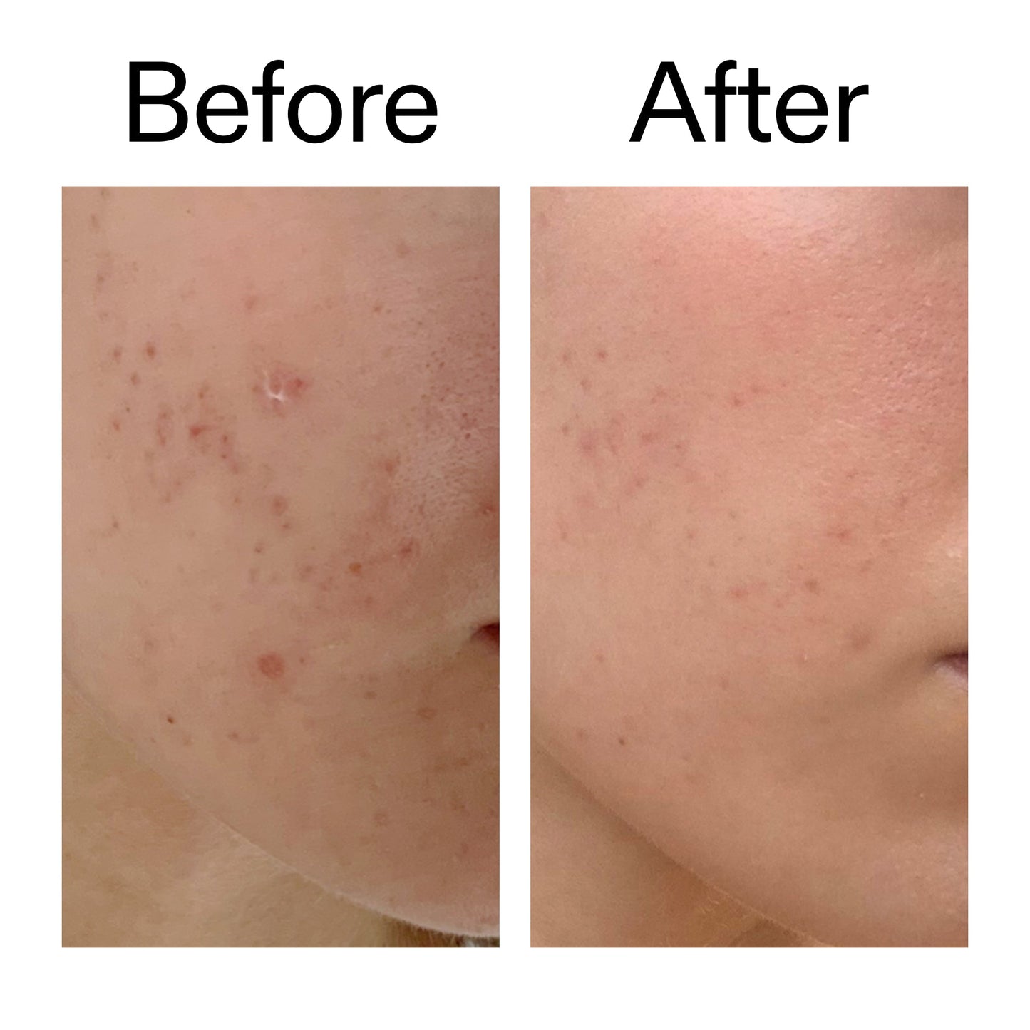 mandelic-acid-treatment-q4 Mandelic_Acid_Treatment_Before_After_2000x2000_4885ac6e-c5d7-4279-a72a-1417af7dce35.jpg