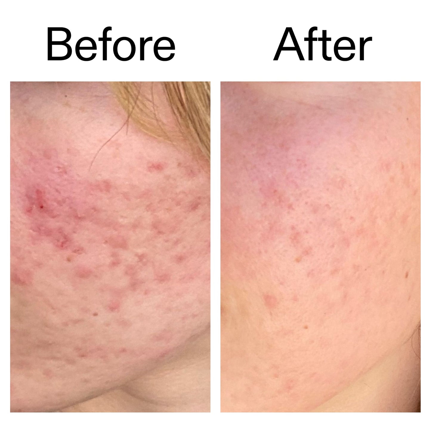 10-azelaic-acid-serum-for-redness-relief-b8 Azealic_Acid_Serum_B_A_Ppage_2000_x_2000.jpg