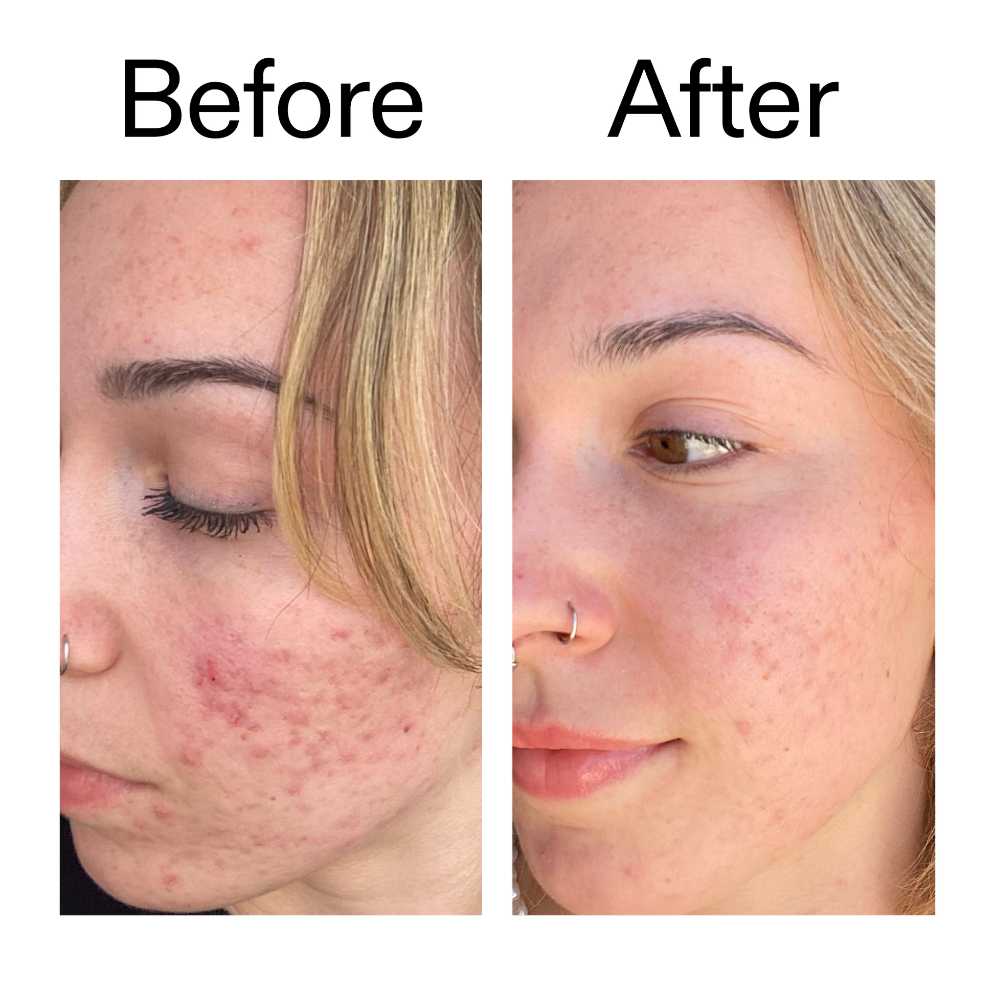 10-azelaic-acid-serum-for-redness-relief-b8 B_A_2_PPAGE.png