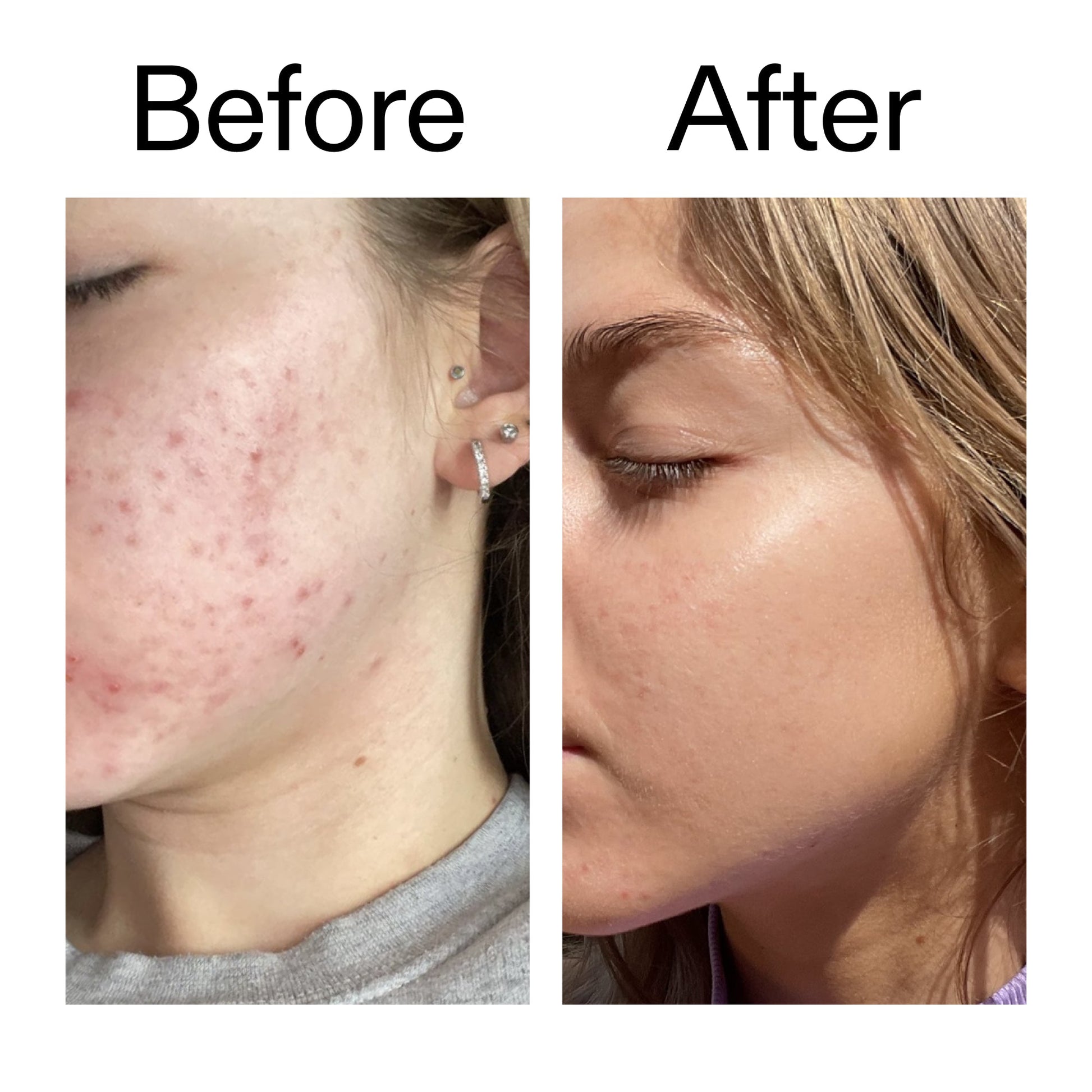 beta-hydroxy-acid-bha-serum-g2 Beta_Hydroxy_Acid_Serum_Before_After_2000x2000_96fda3e5-938d-49ef-bcf2-a0fa6ece4e2c.jpg