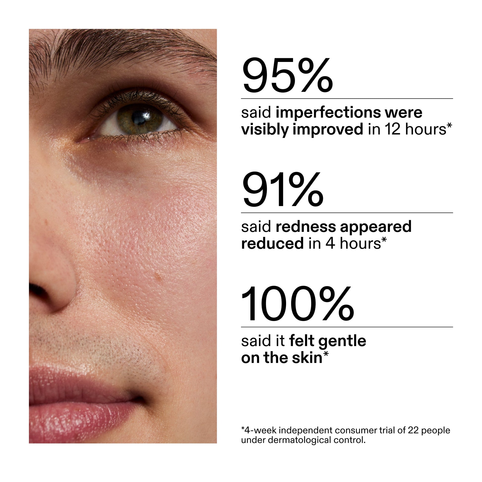 succinic-acid-acne-treatment-q1 CA_Succinic_Acid_Treatment_key_Claims_2000x2000_db91b0f1-7f29-4bfe-bb16-63a47f500960.jpg