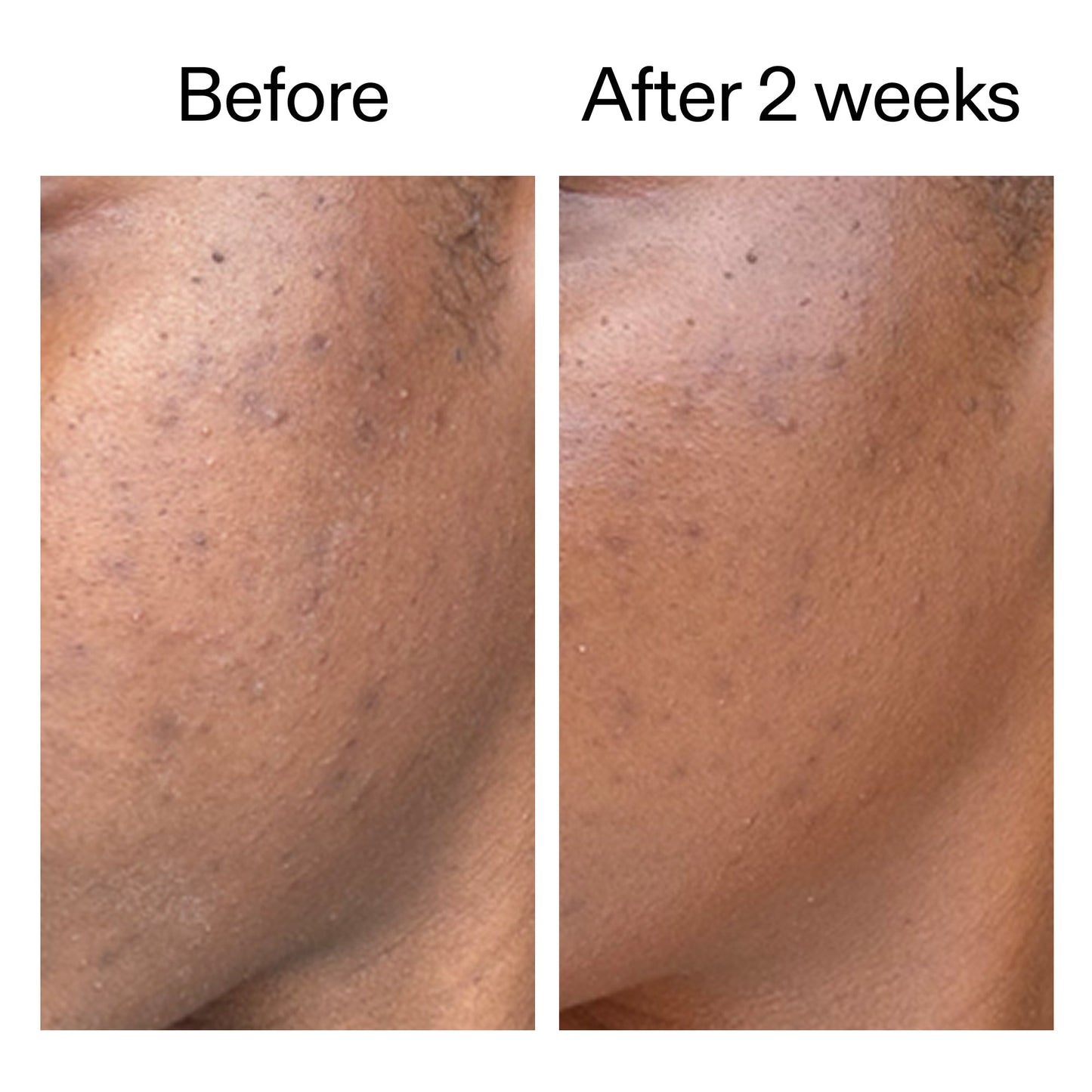 360-acne-clearing-duo-l1 DIOICB_A2000x2000.jpg
