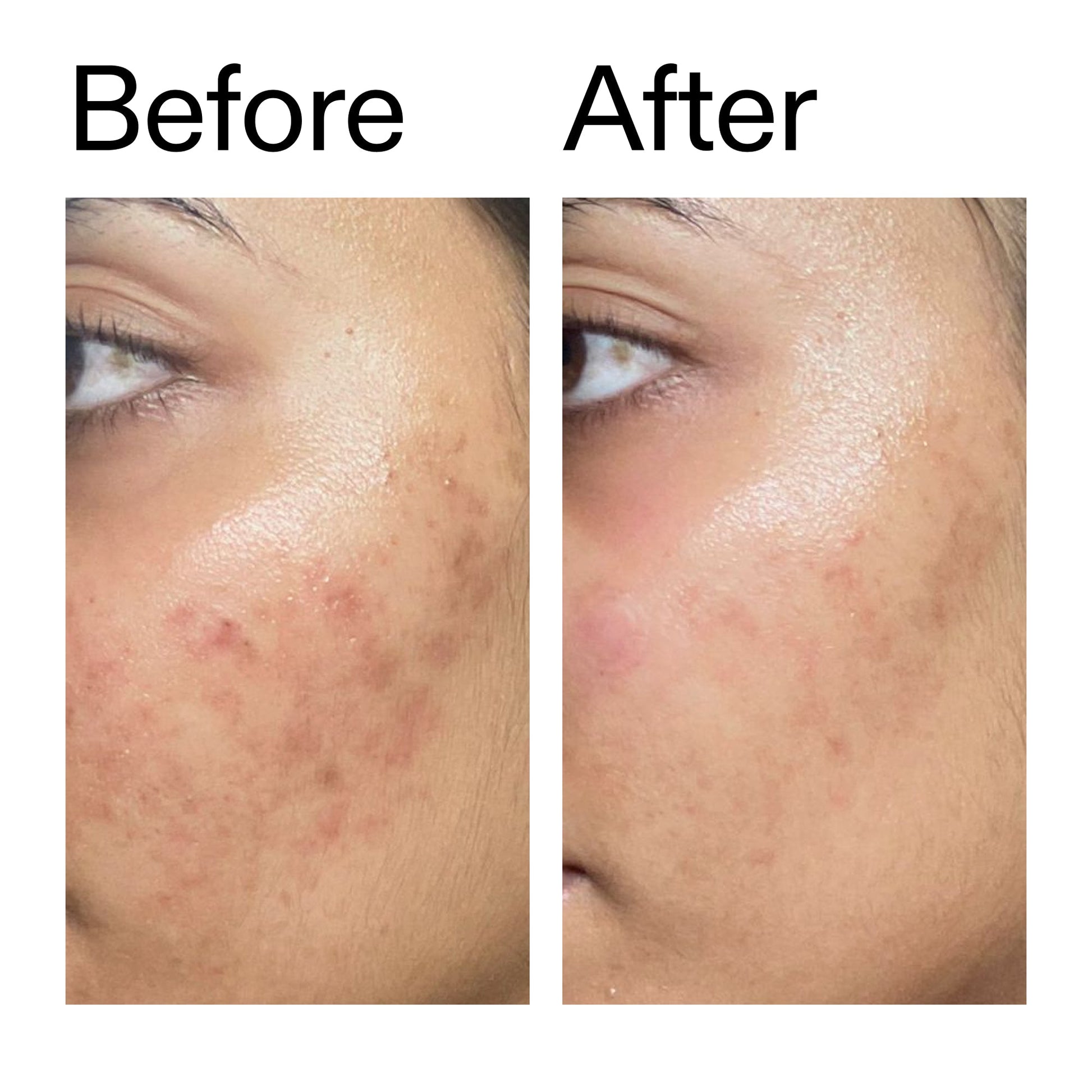 ectoin-hydro-barrier-serum-duo-c9 Ectoin_Hydro-barrier_Serum__Before_After_2000x2000_34261920-d004-48d0-9c7b-8e1c15971bfd.jpg