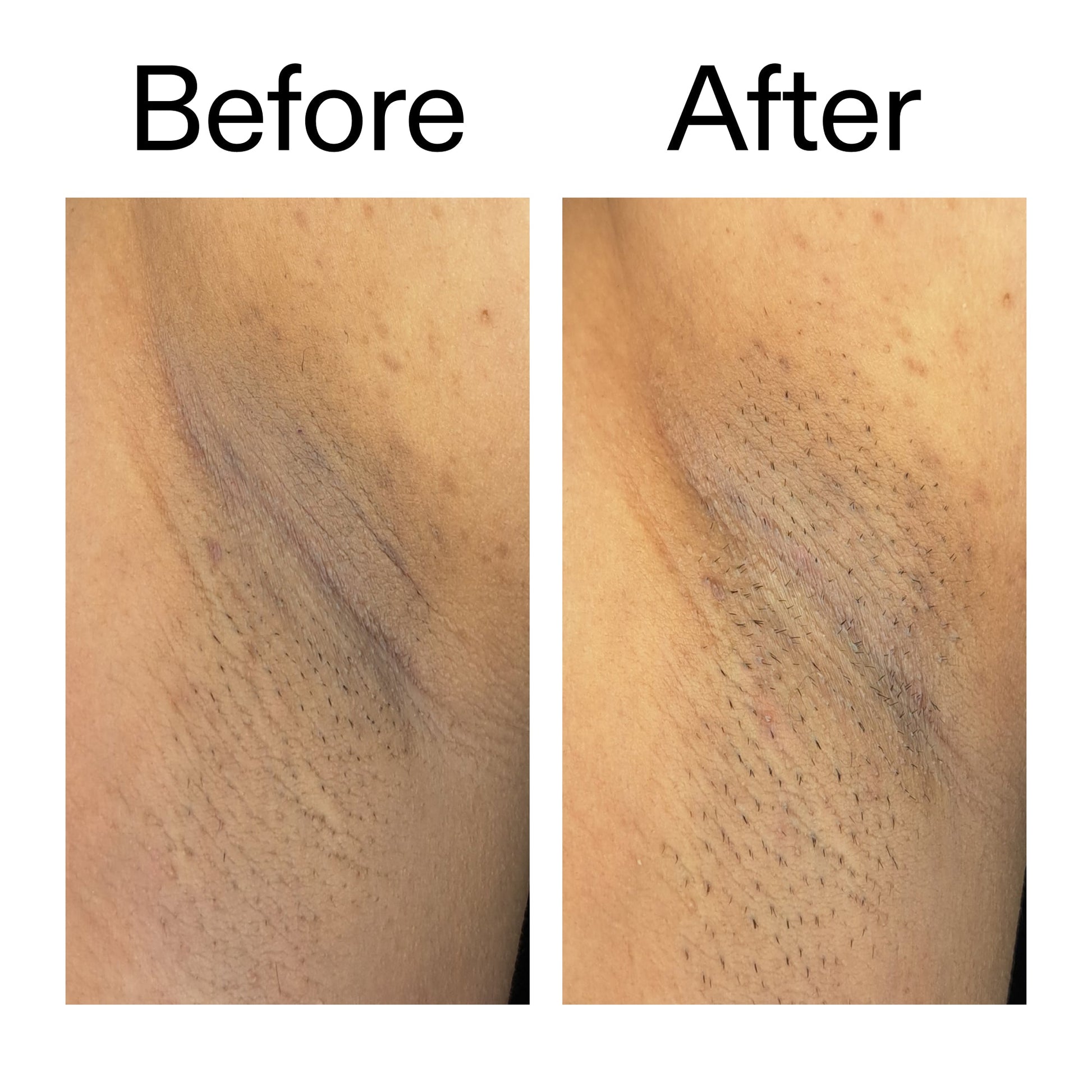 glycolic-acid-exfoliating-body-stick-duo-l8 Glycolic_Acid_Exfoliating_Body_Stick_Before_After_V3_2000x2000_ea919cd9-1439-4a46-82a0-76200eb5bb42.jpg