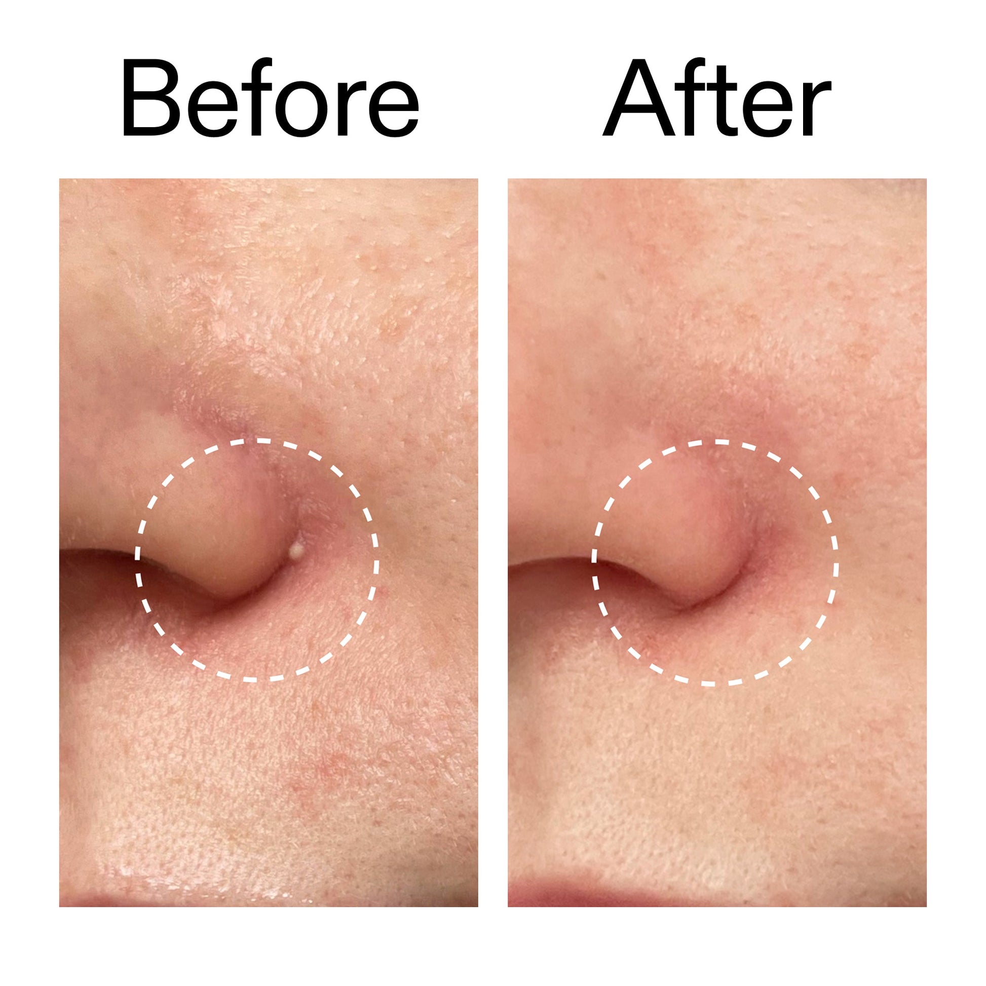 hydrocolloid-invisible-pimple-patches-pack-of-44-j8 Hydrocolloid_Invisible_Pimple_Patches_Before_After_2000x2000_b02aa37b-c78a-4682-91de-9135af5bb7df.jpg