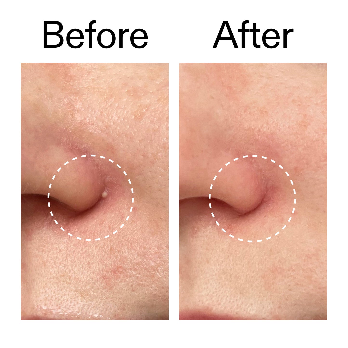 hydrocolloid-invisible-pimple-patches-pack-of-22-k7 Hydrocolloid_Invisible_Pimple_Patches_Before_After_2000x2000_b02aa37b-c78a-4682-91de-9135af5bb7df.jpg