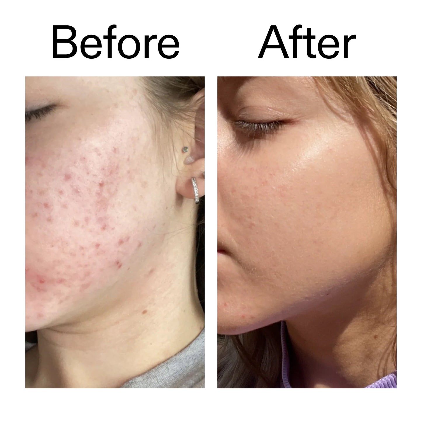 10-niacinamide-serum-duo-b0 Niacinamide_Serum_Before_After_2000x2000_bde32455-9e7d-448e-b053-bef41504f0a9.jpg