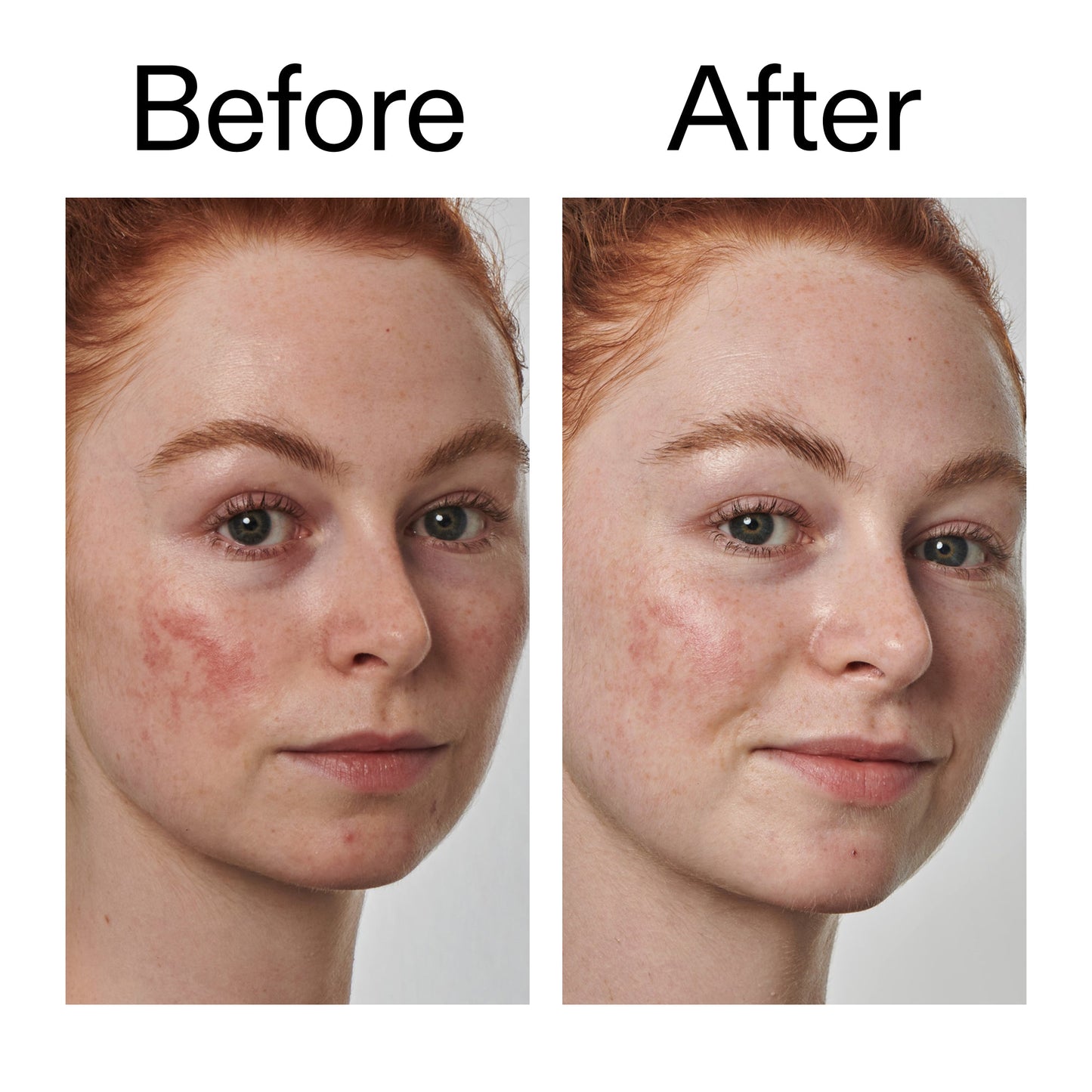 10-azelaic-acid-serum-for-redness-relief-b8 Redness_Relief_Serum_Before_After_2000x2000_3334dc9a-cce9-4e00-8aec-7ad89ca051f2.jpg