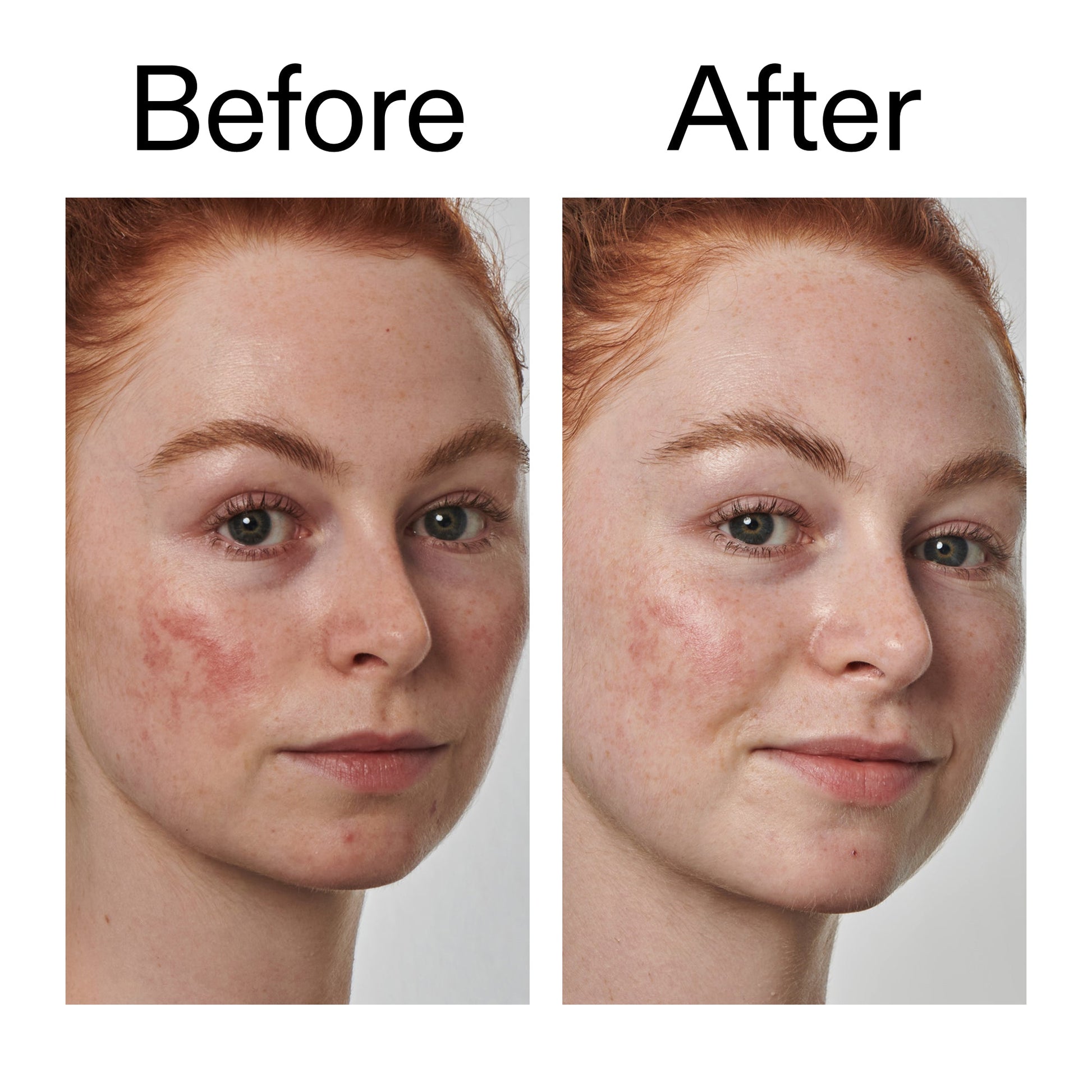 10-azelaic-acid-serum-for-redness-relief-b8 Redness_Relief_Serum_Before_After_2000x2000_3334dc9a-cce9-4e00-8aec-7ad89ca051f2.jpg