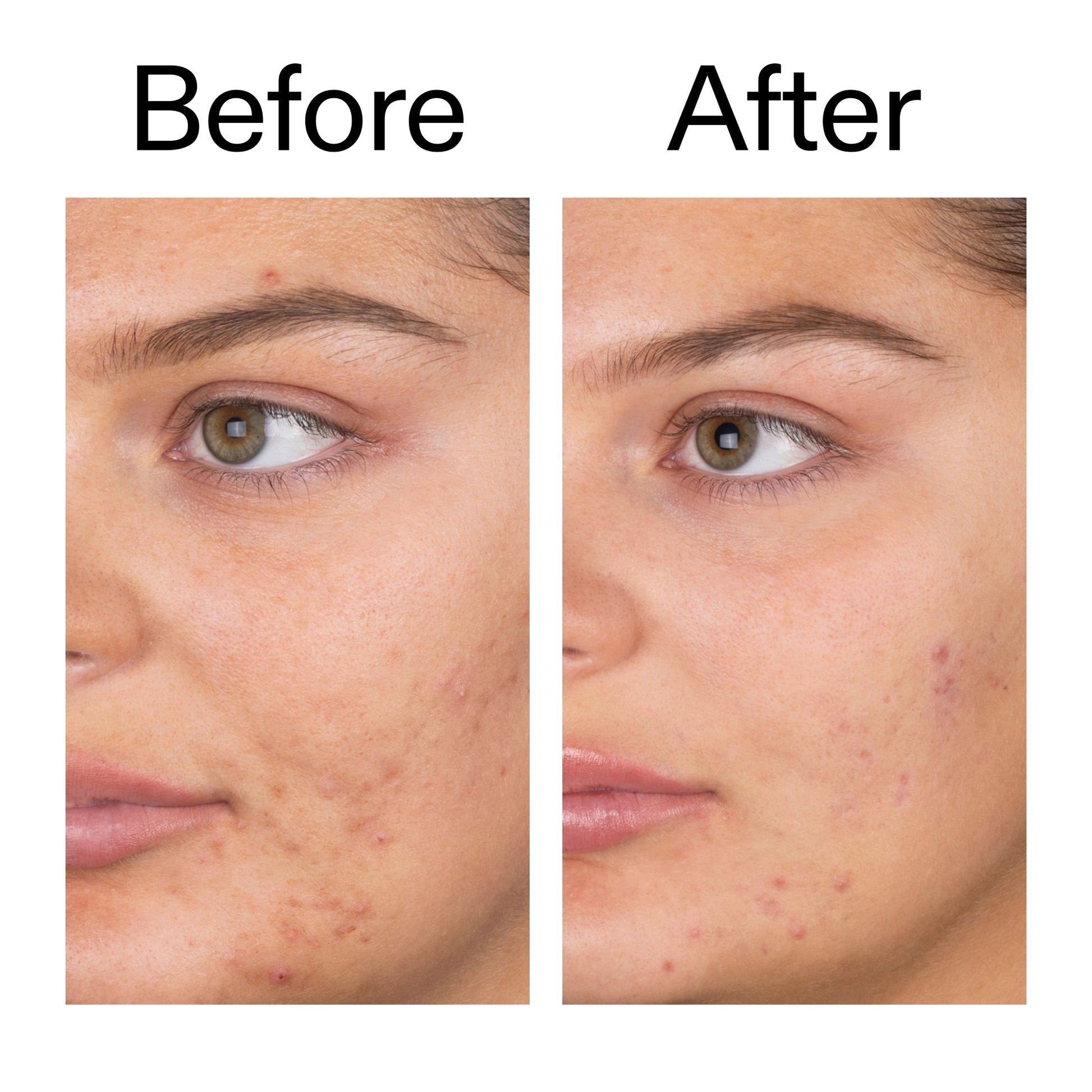 salicylic-acid-cleanser-150ml-d7 Salicylic_Acid_Cleanser_-_150ml_Before_After_2000x2000_e7230494-853f-4b07-82b1-27669104c995.jpg