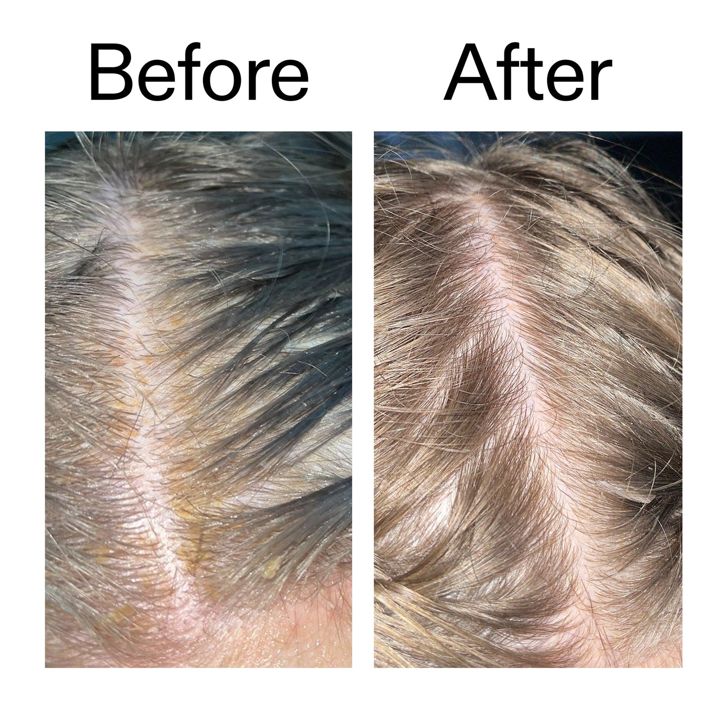 salicylic-acid-exfoliating-scalp-treatment-c9 Salicylic_Acid_Exfoliating_Scalp_Treatment_Before_After_2000x2000_e572a30f-057c-4a48-823b-1c09dc97f8d0.jpg