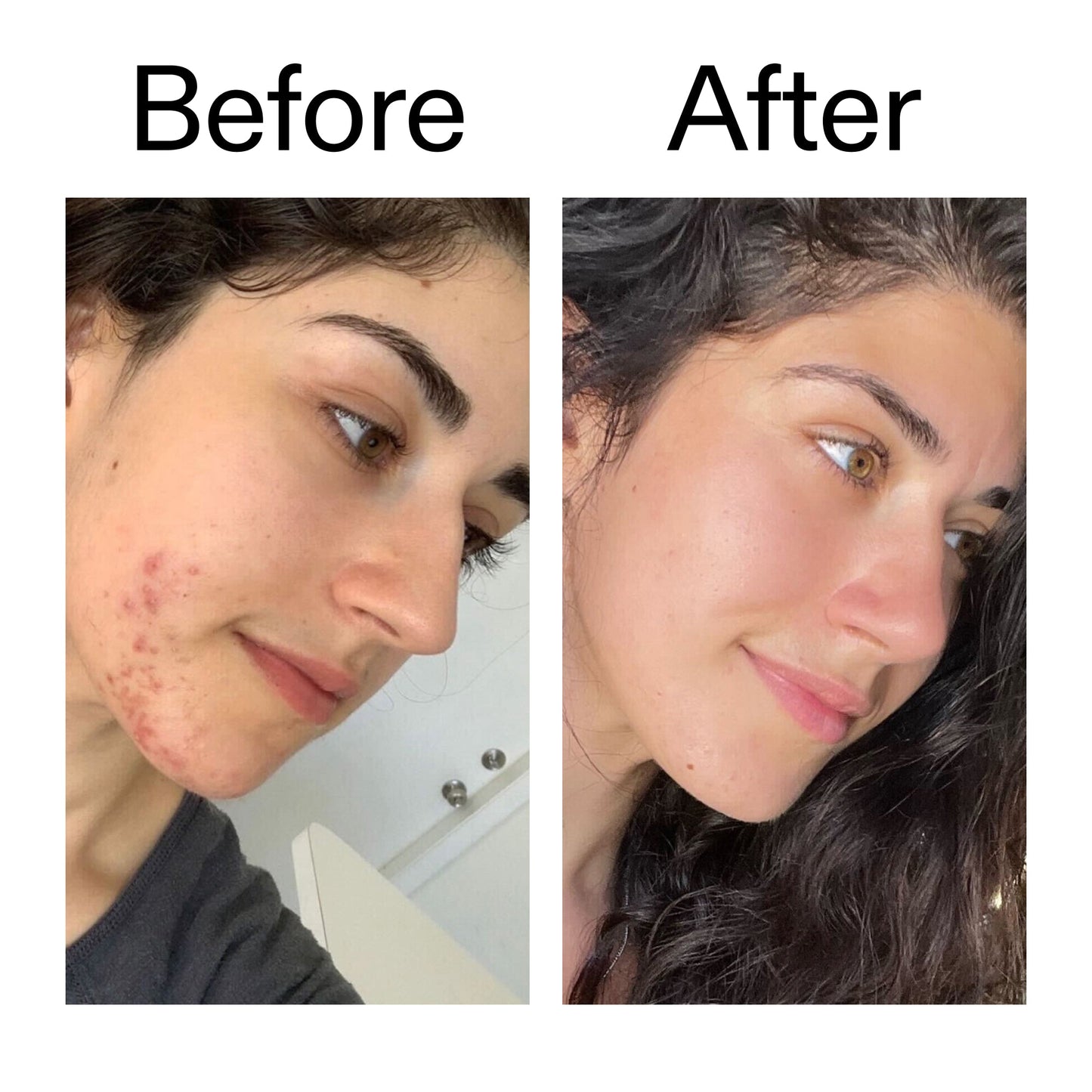 succinic-acid-acne-treatment-q1 Succinic_Acid_Treatment_Before_After_2000x2000_6a5f0054-2f58-4433-9314-0dc72c9bdd3b.jpg