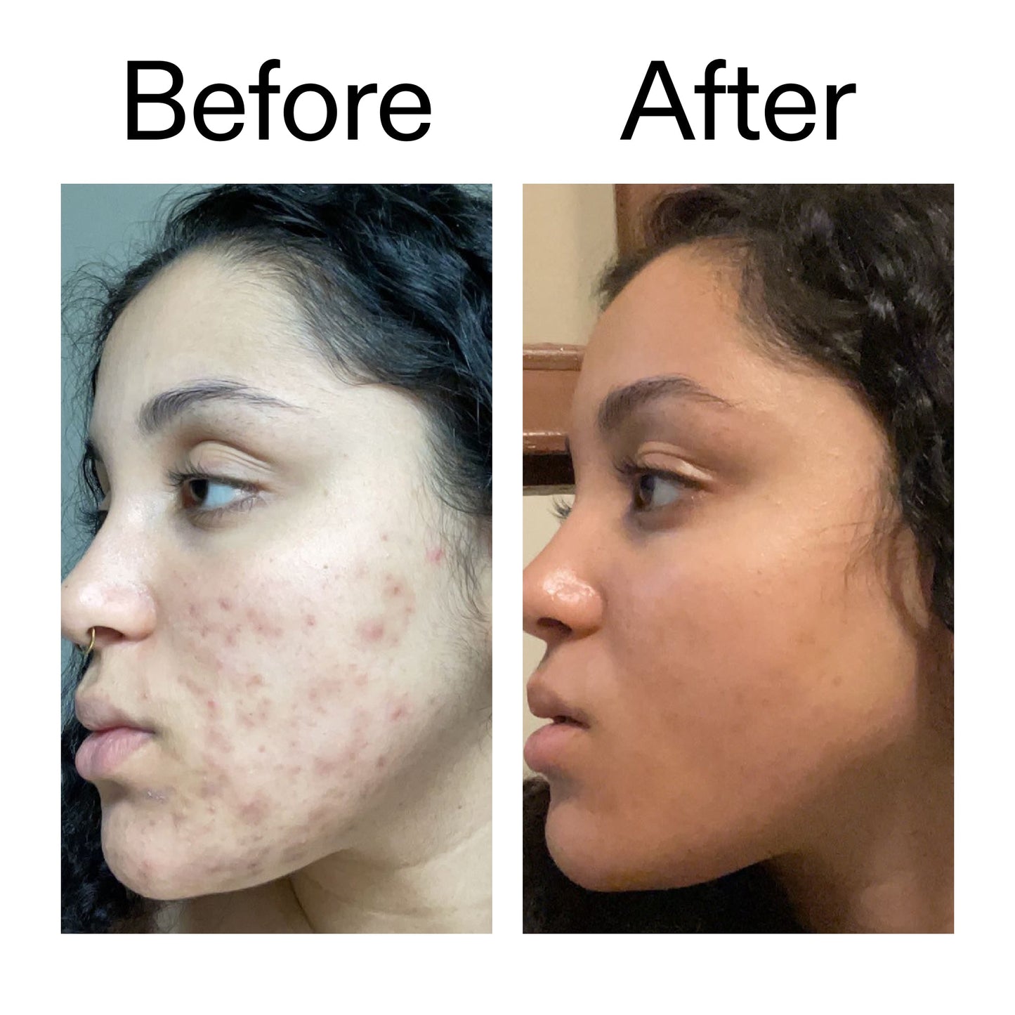 tranexamic-acid-serum-s7 Tranexamic_Acid_Serum_Before_After_2000x2000_98ebc8be-77b0-4843-8a22-90790ebe918b.jpg
